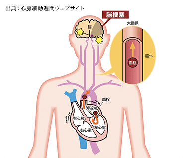 治療法は① 脳梗塞予防薬の内服② 動悸・心不全症状緩和の内服