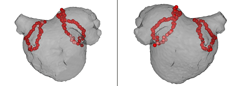 3D mapping systemによる治療画像