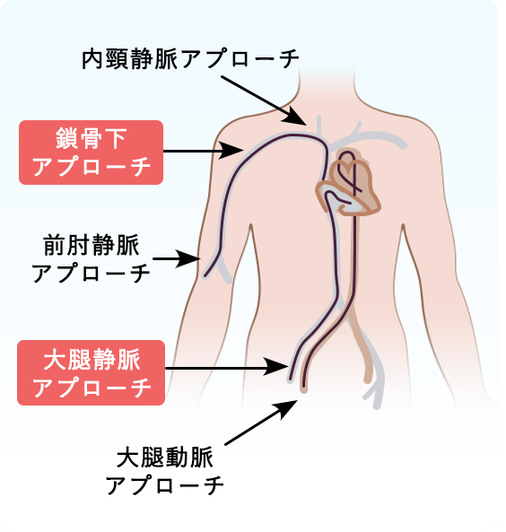 穿刺部位について