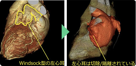 血栓が生じやすい左心耳を切除するため脳梗塞予防効果が得られます。