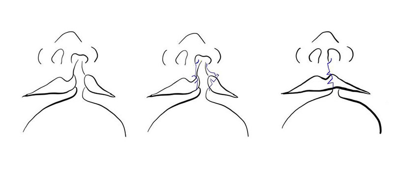 片側口唇裂に対する口唇形成術