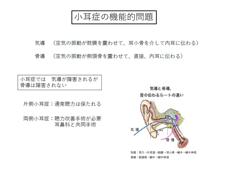 小耳症