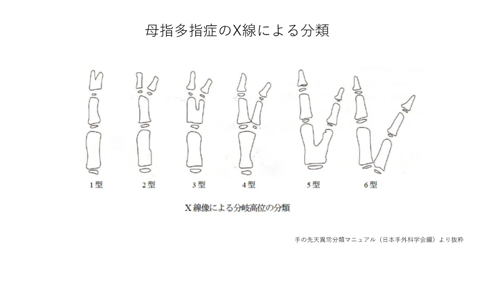 母指多指症