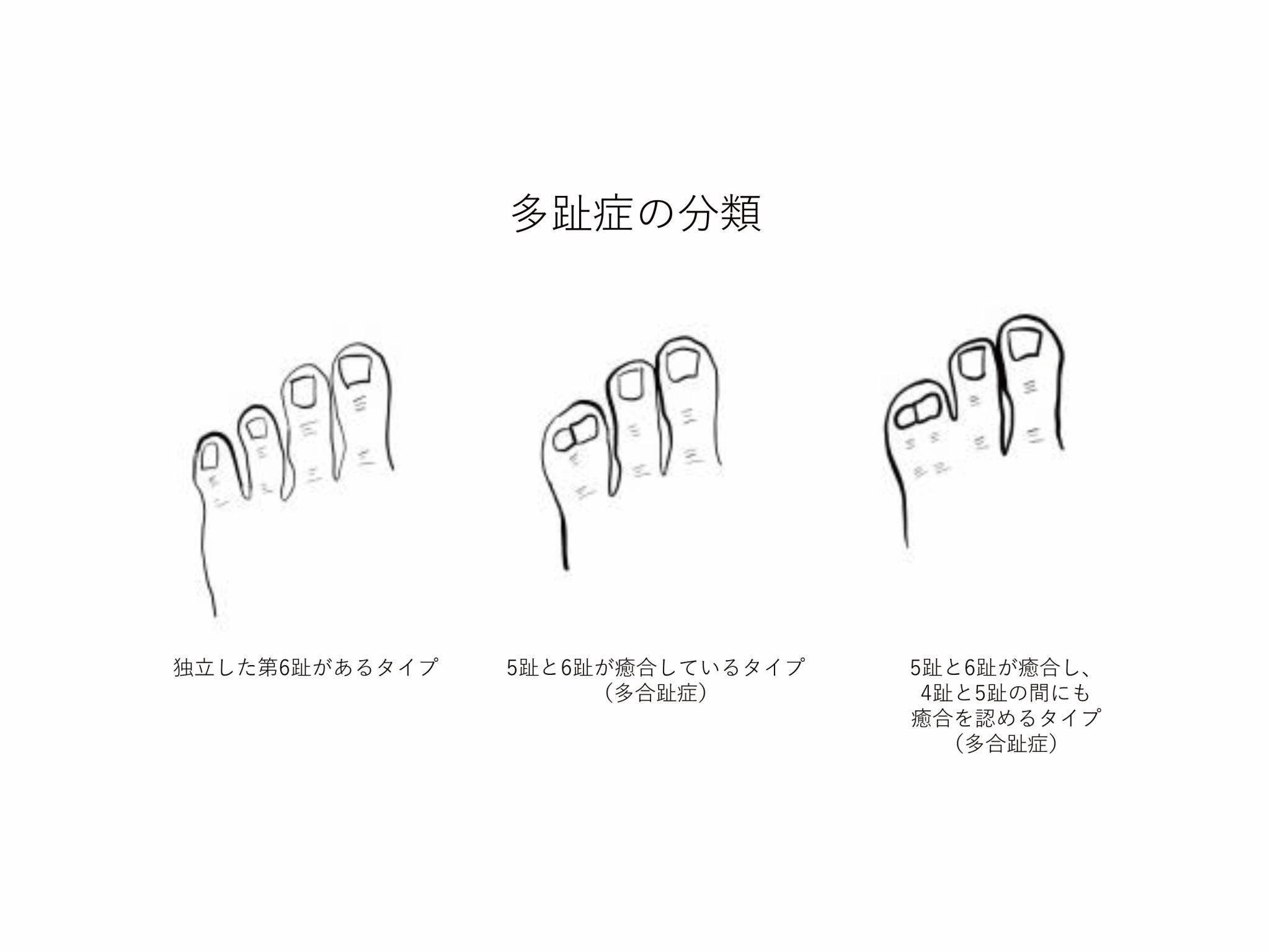 母指多指症、合指症、多合趾症などの四肢先天異常 | 小児形成外科疾患について | 形成外科・小児形成外科 | 外科系診療科 | 診療科・部門 ...